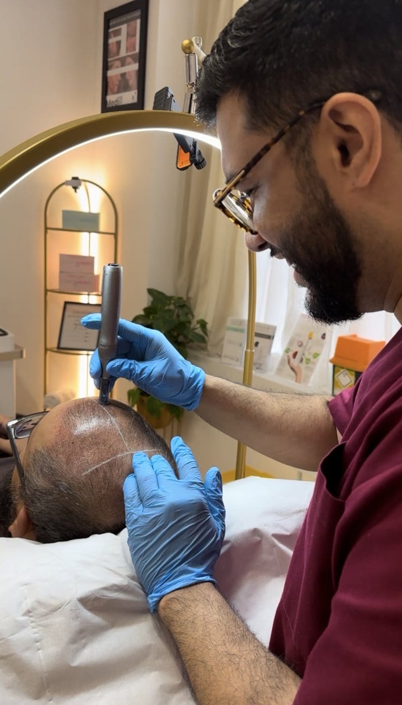 Arman Zaki performing EXO-GROW scalp microneedling with a microneedling pen on a client at Melatone Skin Clinic Battersea, an exosome treatment for hair and scalp