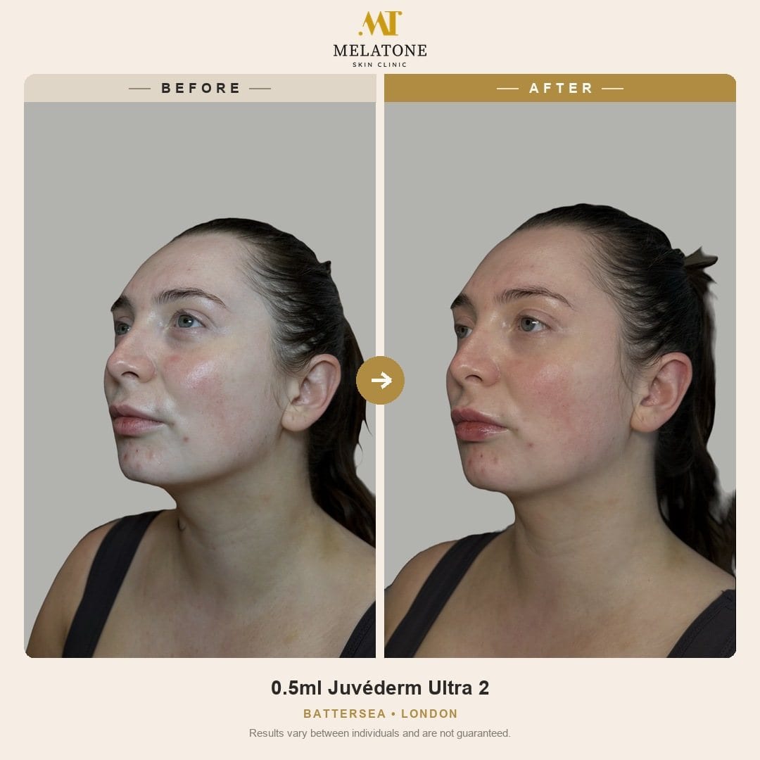 Before and after of a natural 0.5ml Juvéderm Ultra 2 lip filler result at Melatone Skin Clinic, Battersea, London