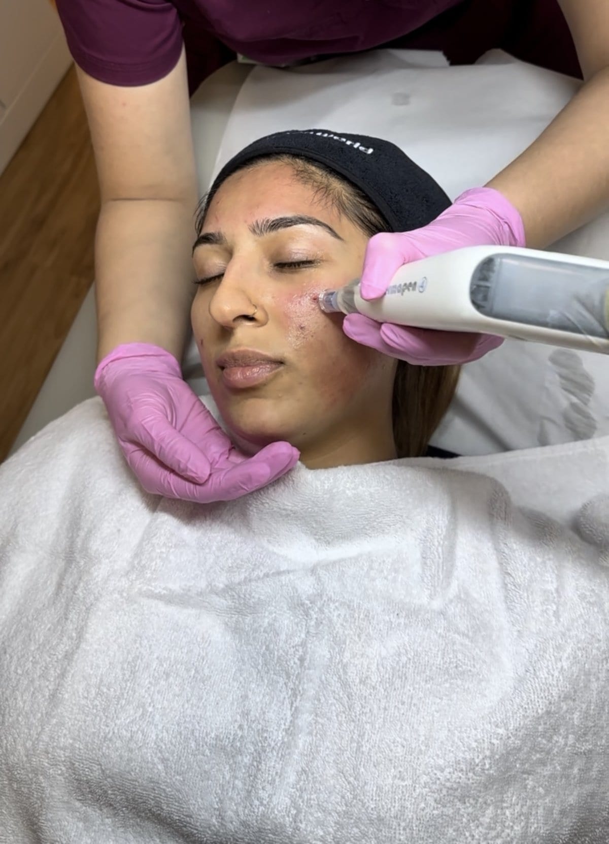 A clinician at Melatone Skin Clinic Battersea performing microneedling, treating acne scars and skin texture on a patient