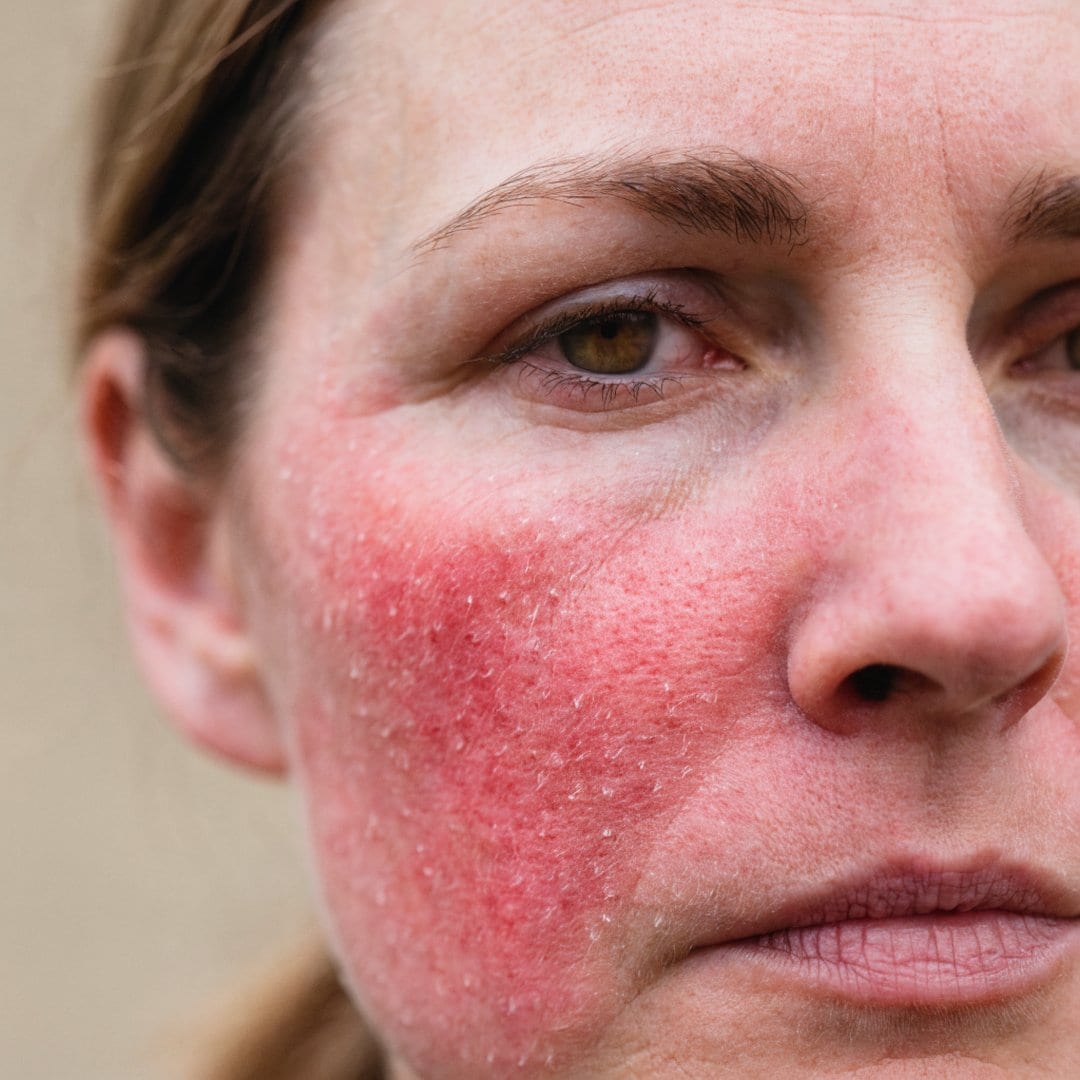 Close-up of a red, compromised skin barrier