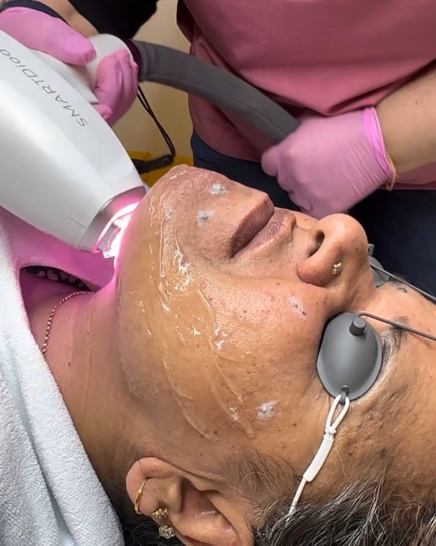 SMARTDiode laser on Fitzpatrick V skin at Melatone Skin Clinic Battersea, with eye protection and settings chosen for the patient's tone
