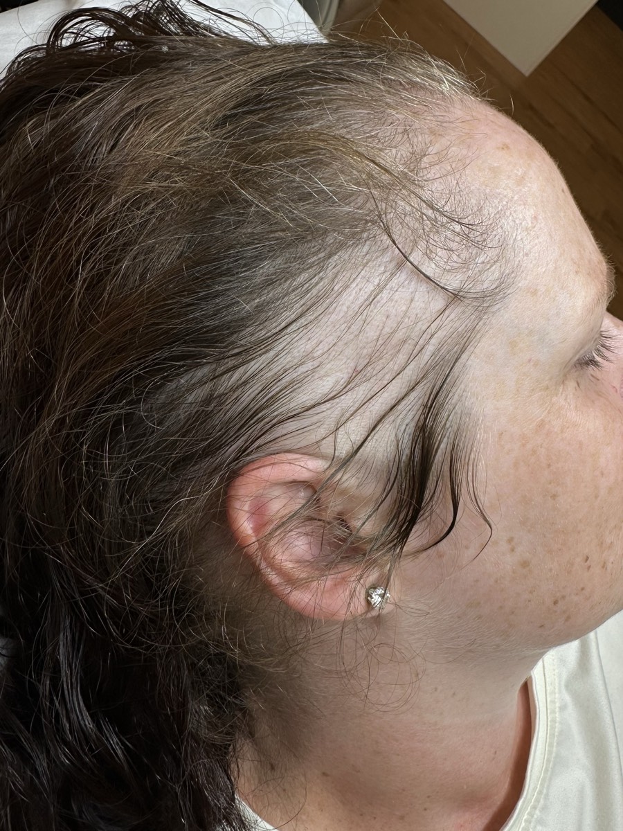 Right temple of the same patient with traction alopecia, showing matching thinning and recession along the hairline with a retained fringe of hair at the margin.
