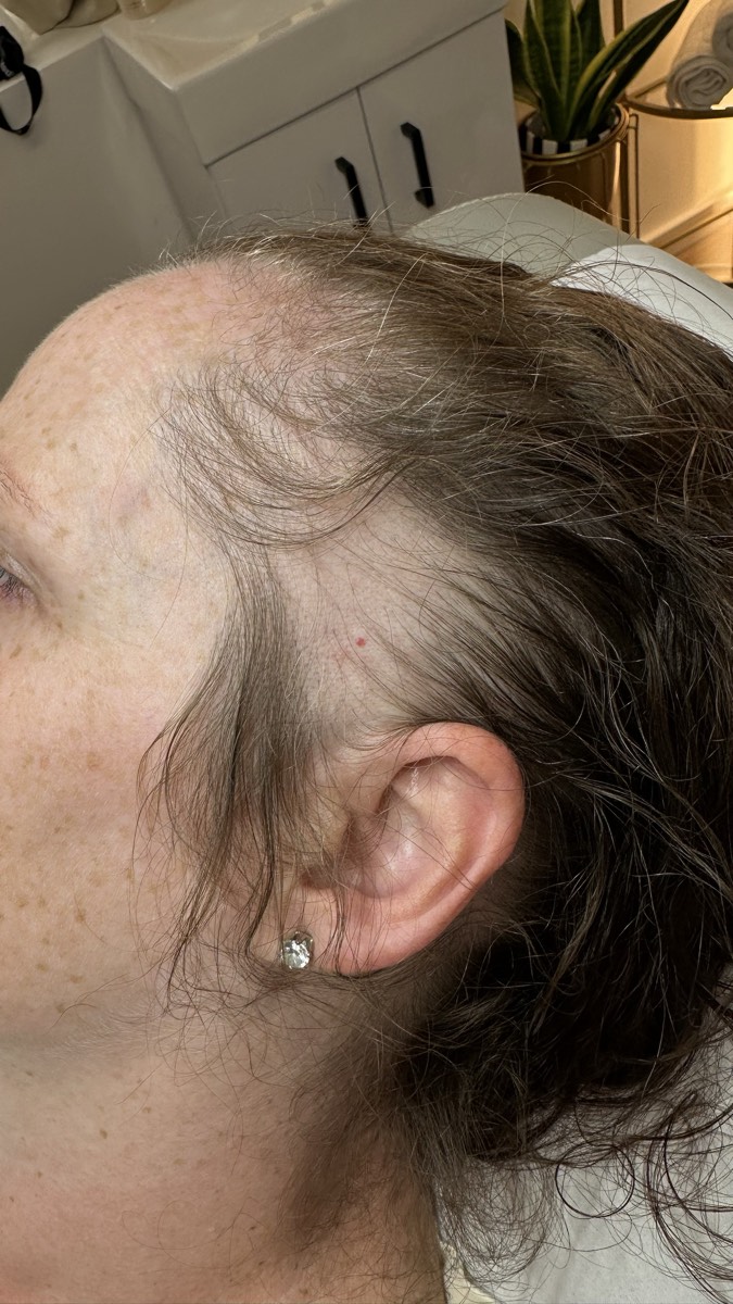 Left temple of a patient with traction alopecia, showing thinning and recession along the hairline with a retained fringe of hair at the margin.