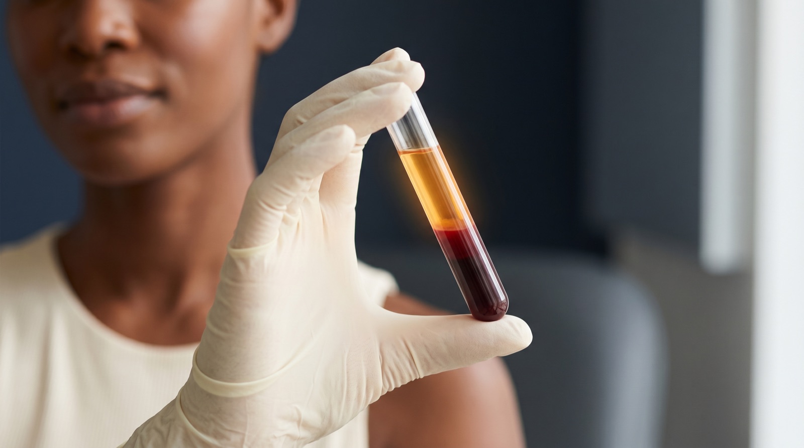 Centrifuged platelet-rich plasma, the golden plasma layer separated from red blood cells, beside calm Fitzpatrick V to VI skin, at Melatone Skin Clinic Battersea