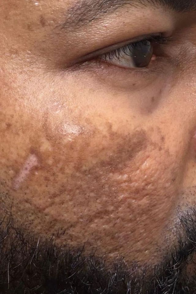 Skin before using ESK skincare, example 1