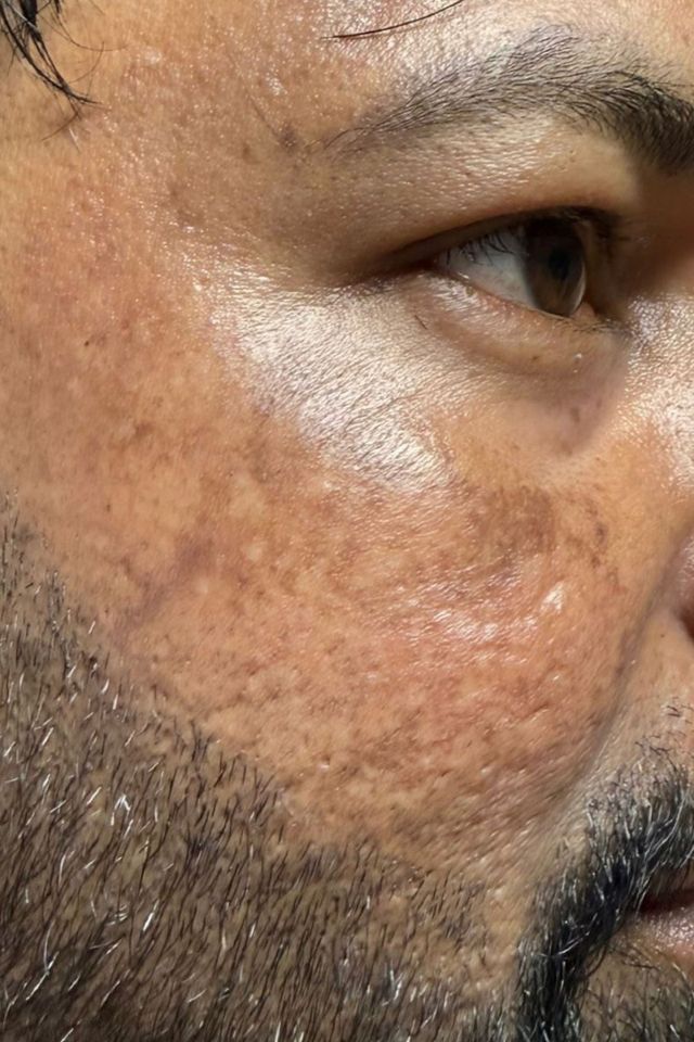 Skin after using ESK skincare, example 1