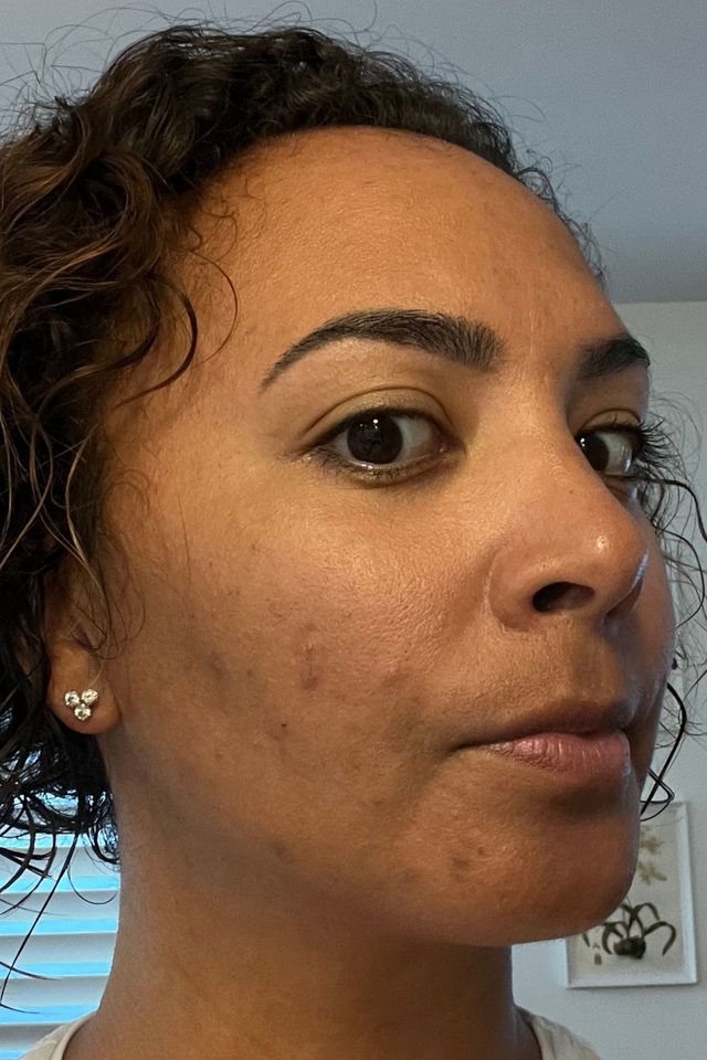 Skin before using ESK skincare, example 2