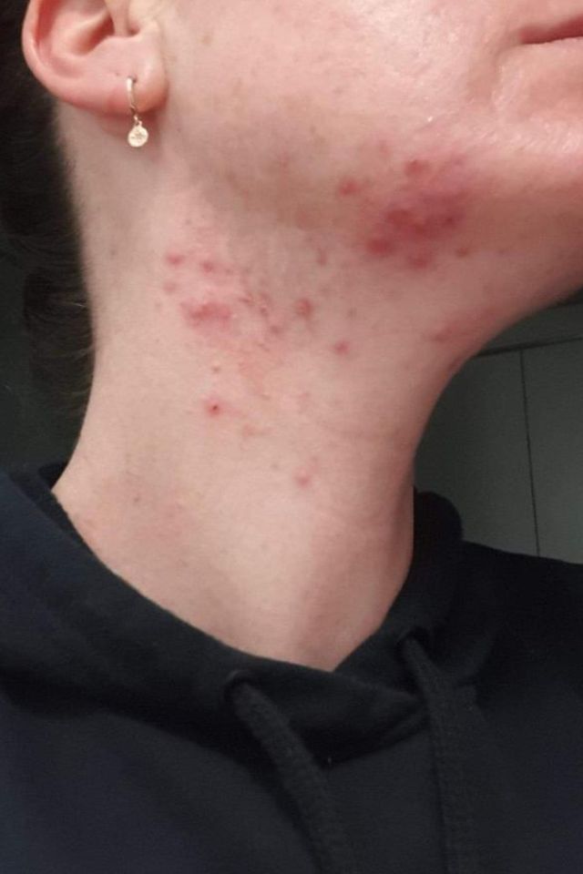 Skin before using ESK skincare, example 3