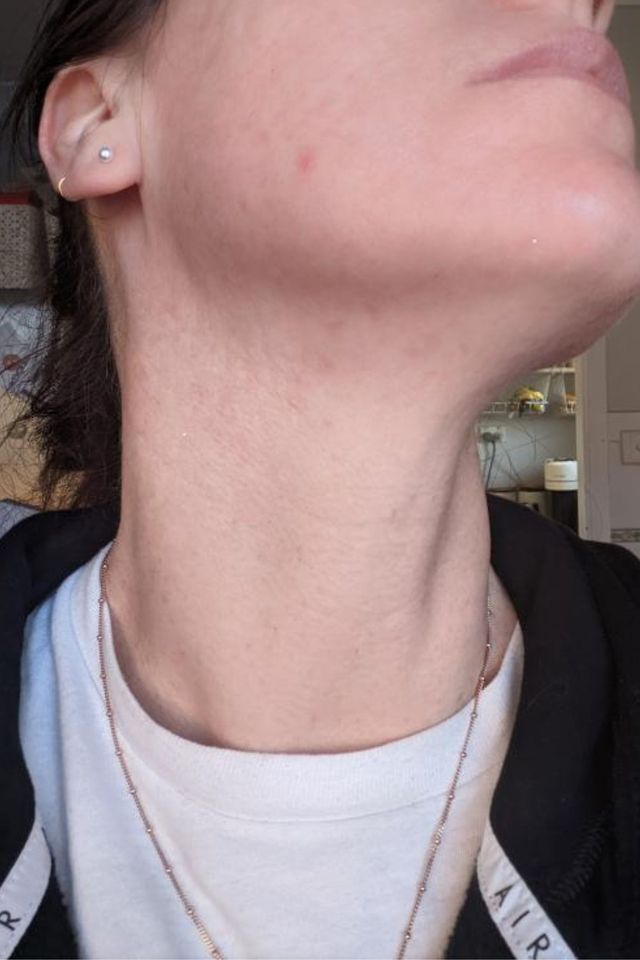 Skin after using ESK skincare, example 3