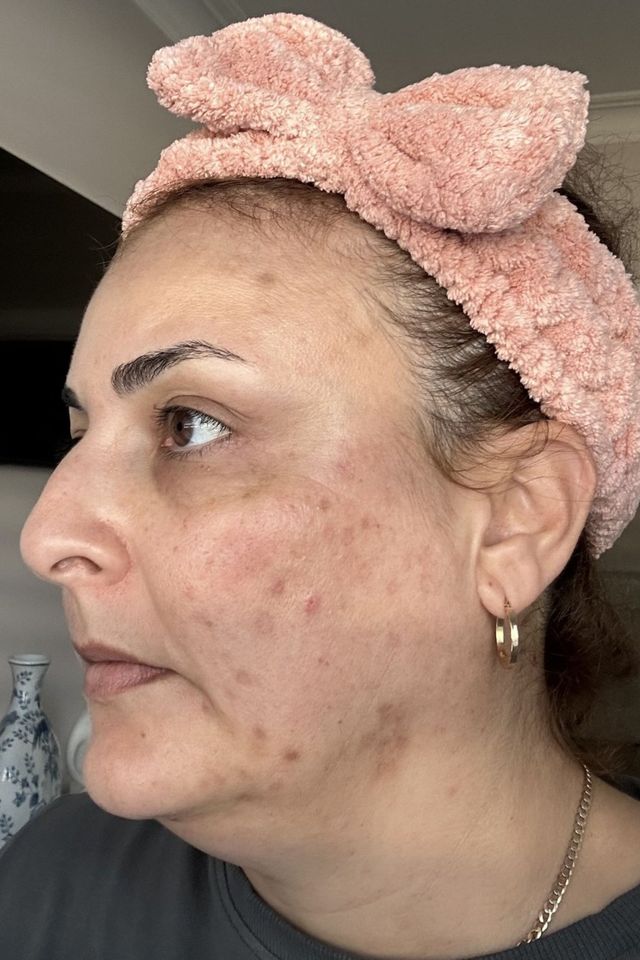 Skin before using ESK skincare, example 4