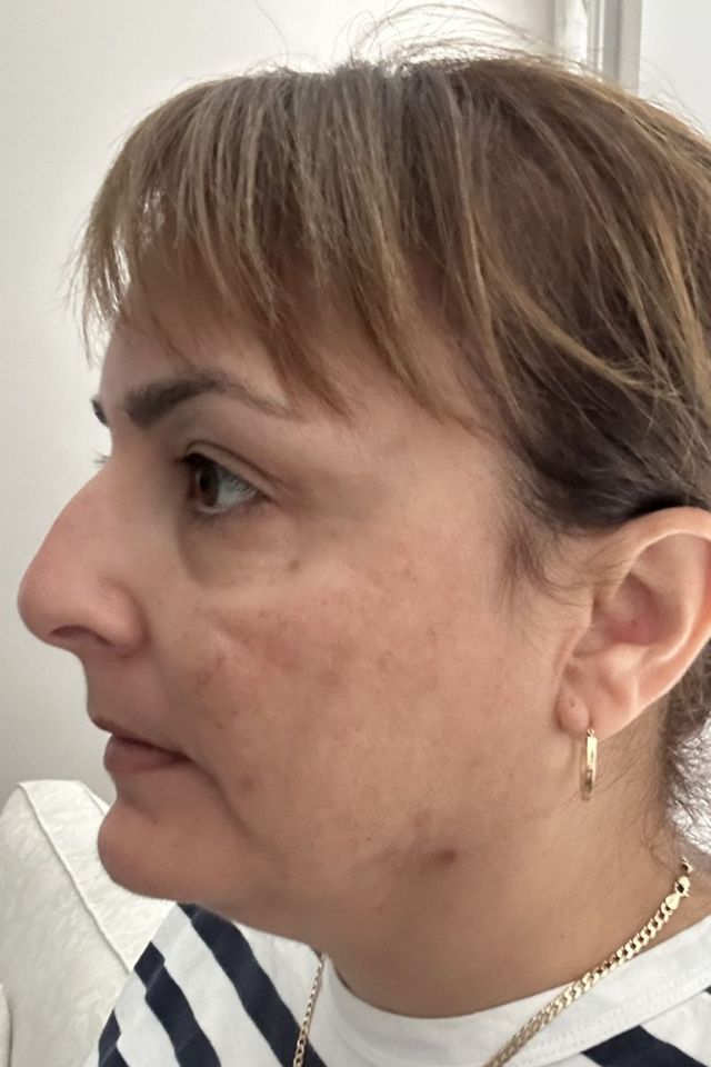 Skin after using ESK skincare, example 4