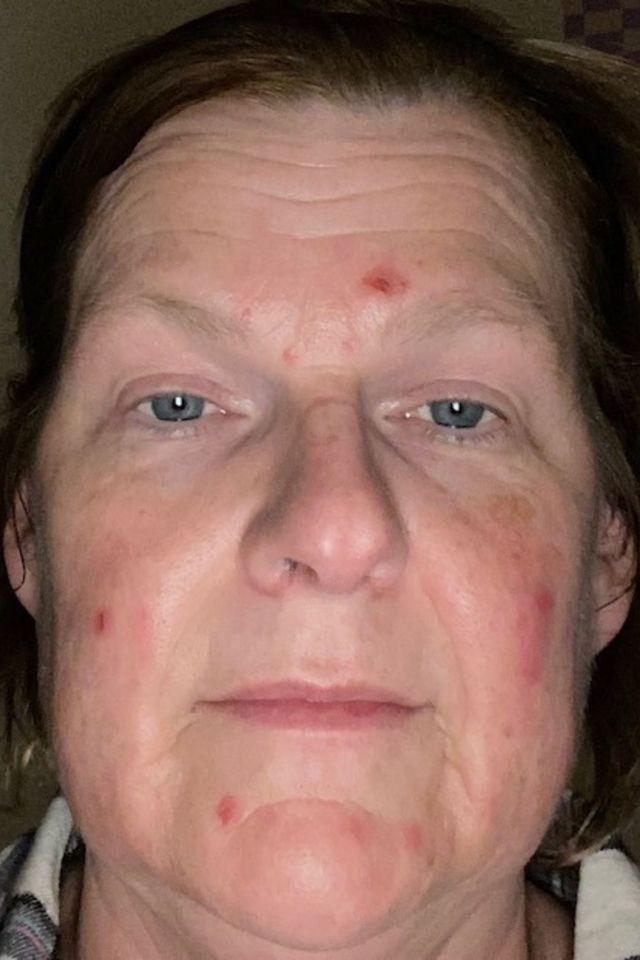 Skin before using ESK skincare, example 5