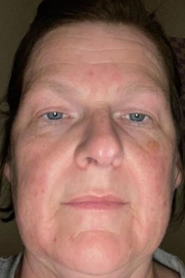Skin after using ESK skincare, example 5