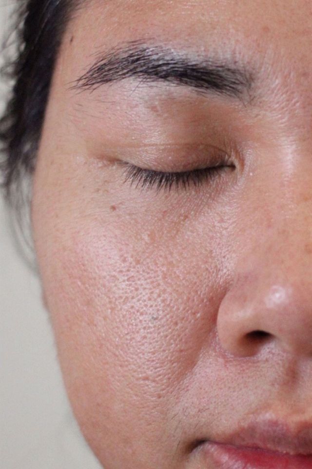 Skin before using ESK skincare, example 6