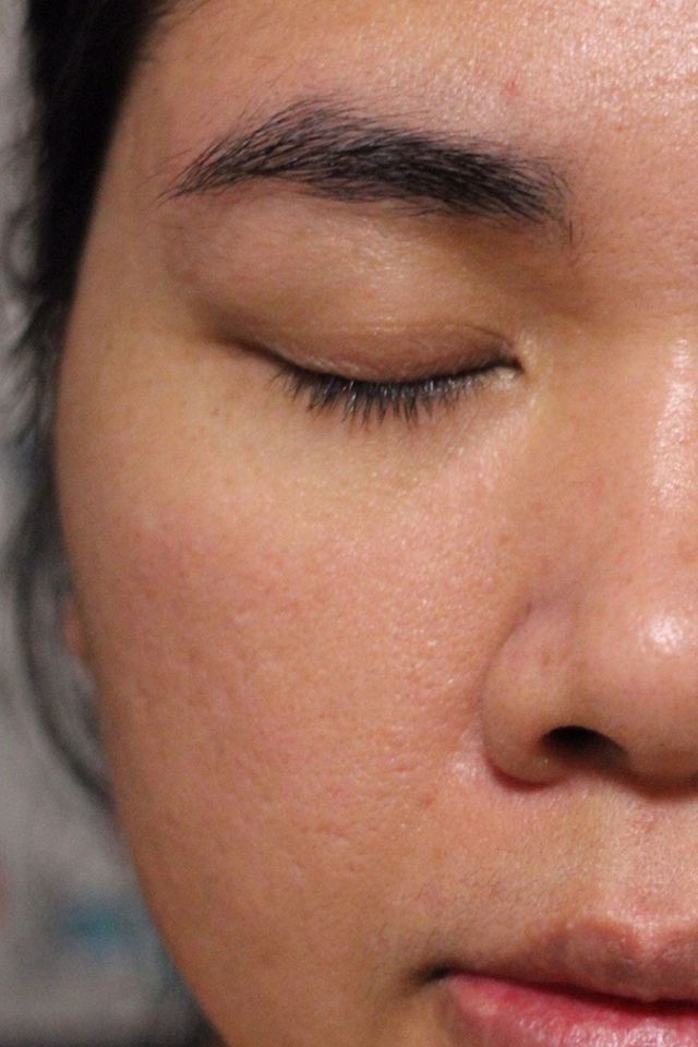Skin after using ESK skincare, example 6