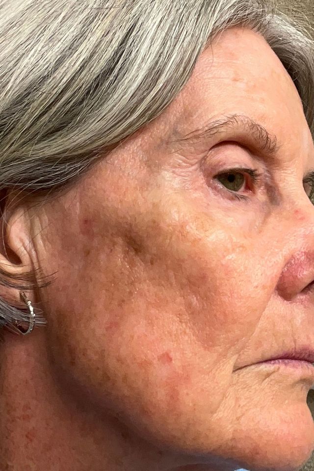 Skin before using ESK skincare, example 7