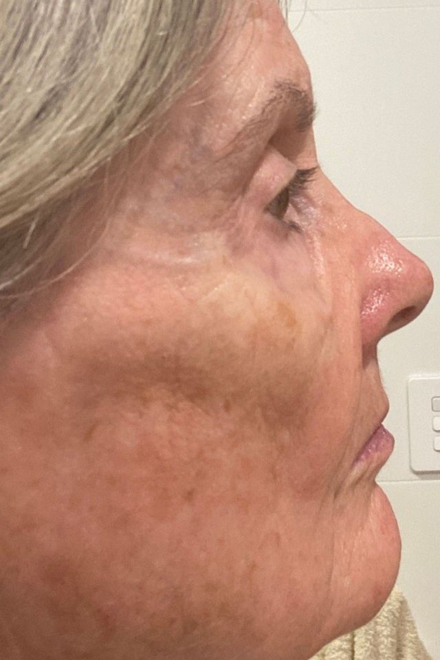 Skin after using ESK skincare, example 7