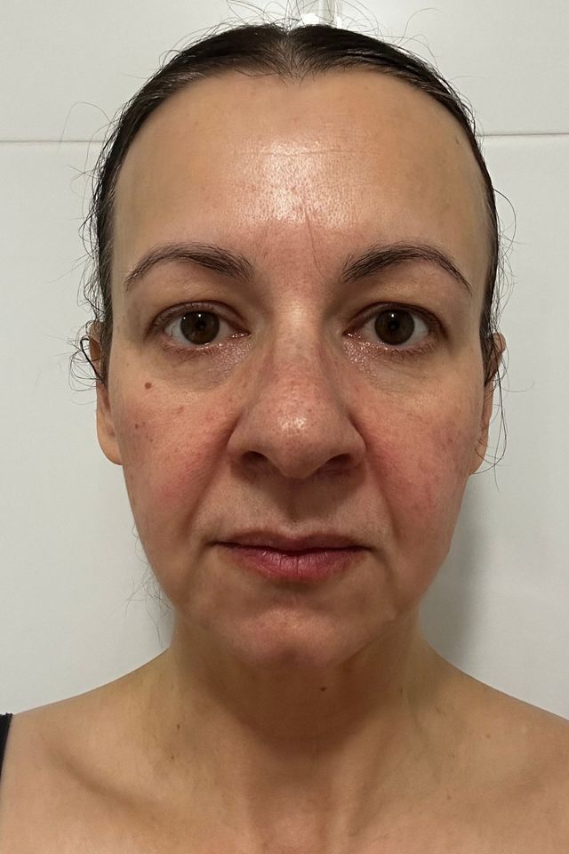 Skin before using ESK skincare, example 8