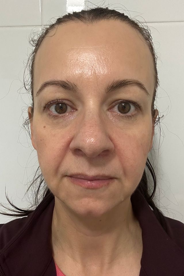 Skin after using ESK skincare, example 8