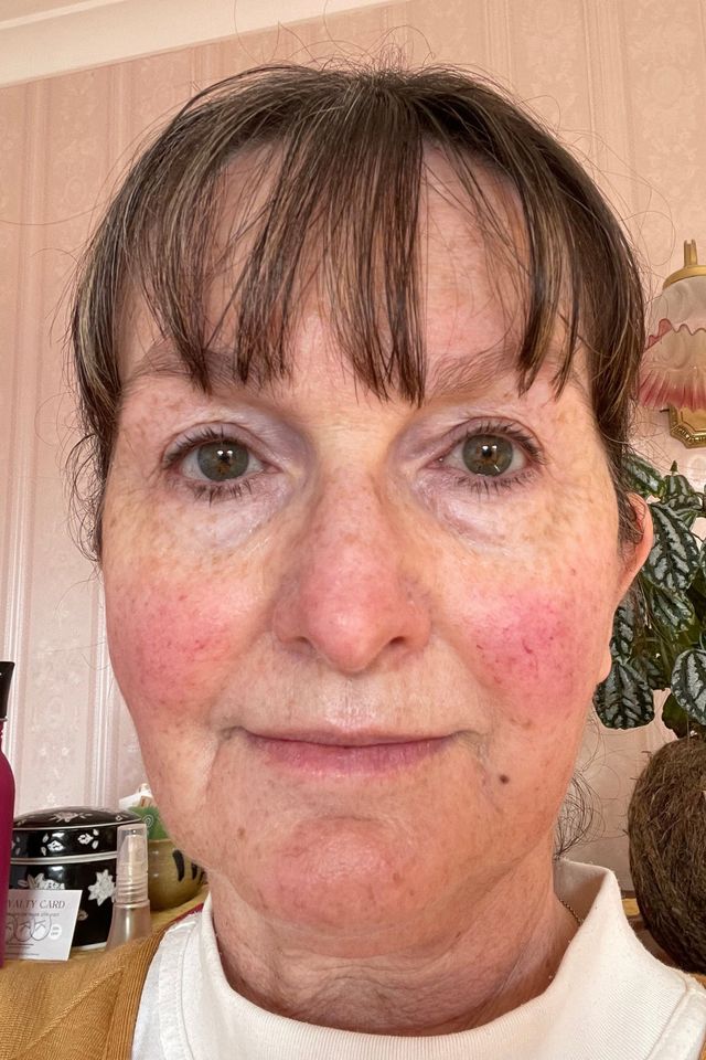 Skin before using ESK skincare, example 9
