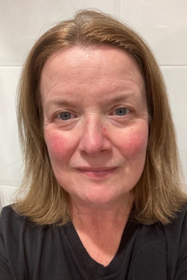 Skin before using ESK skincare, example 10