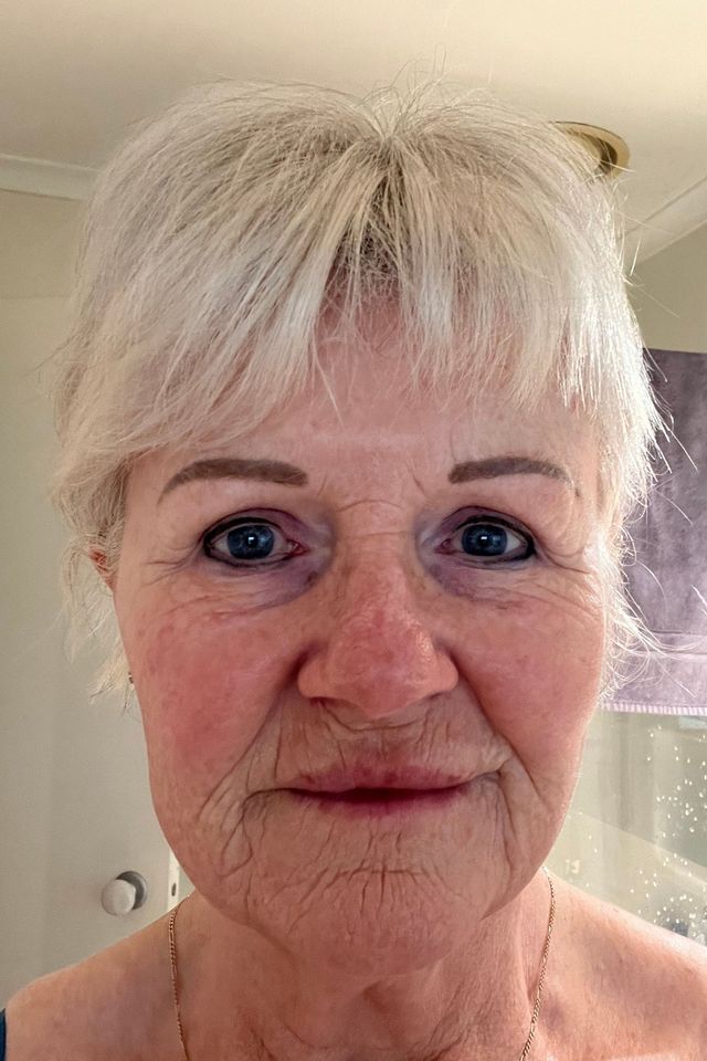 Skin before using ESK skincare, example 11