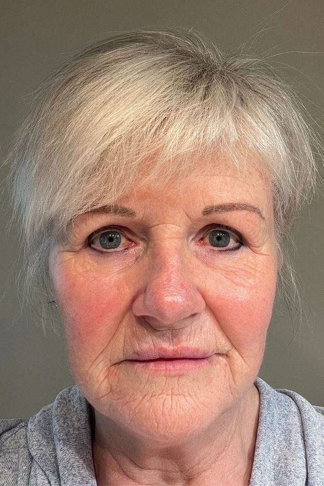 Skin after using ESK skincare, example 11