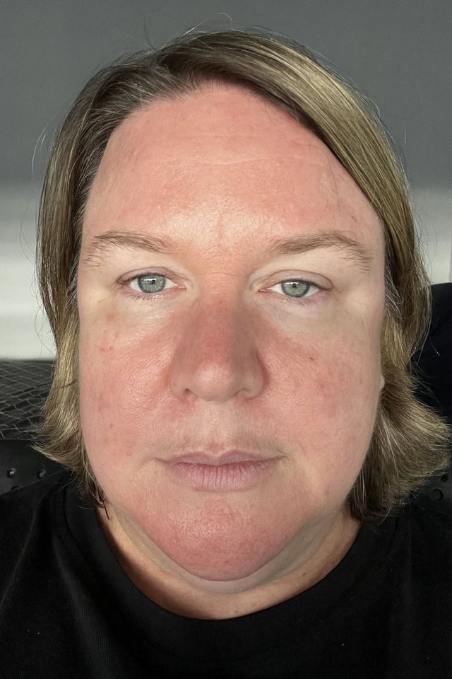 Skin before using ESK skincare, example 12