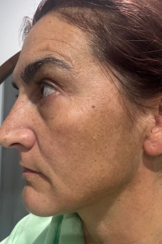 Skin before using ESK skincare, example 13