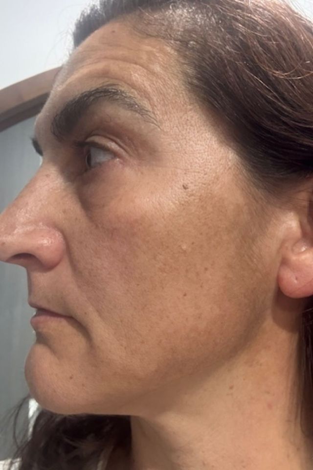 Skin after using ESK skincare, example 13