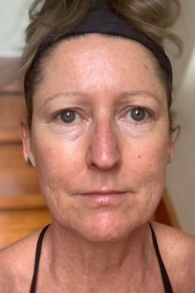 Skin before using ESK skincare, example 14