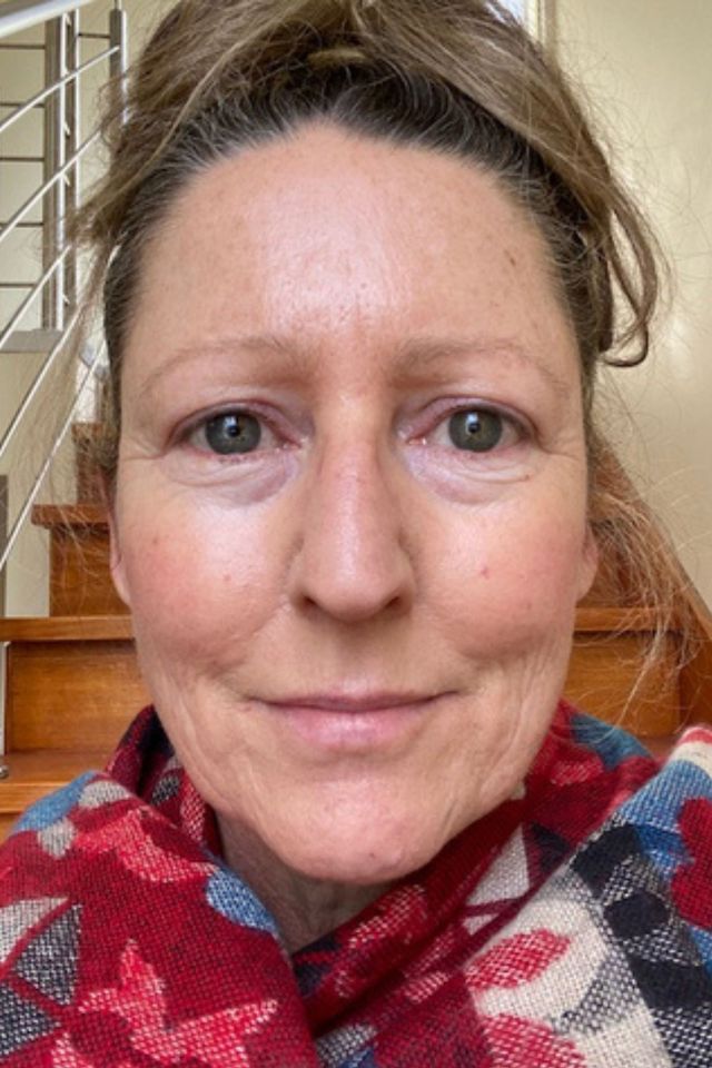 Skin after using ESK skincare, example 14
