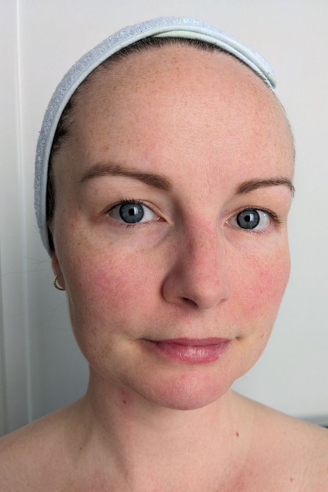Skin before using ESK skincare, example 15