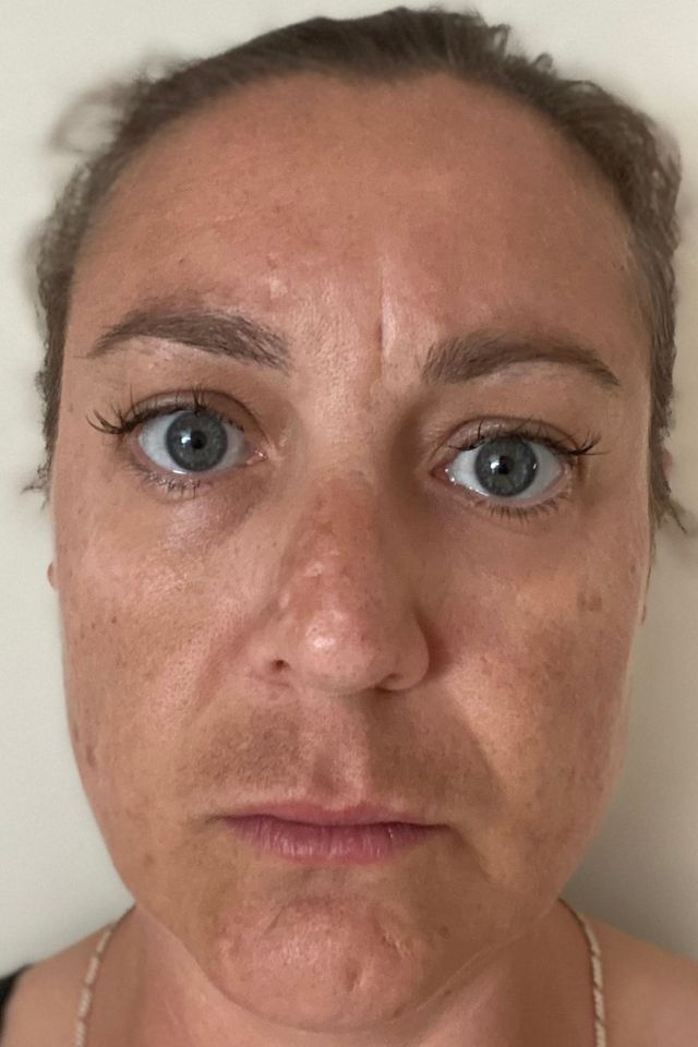 Skin before using ESK skincare, example 16