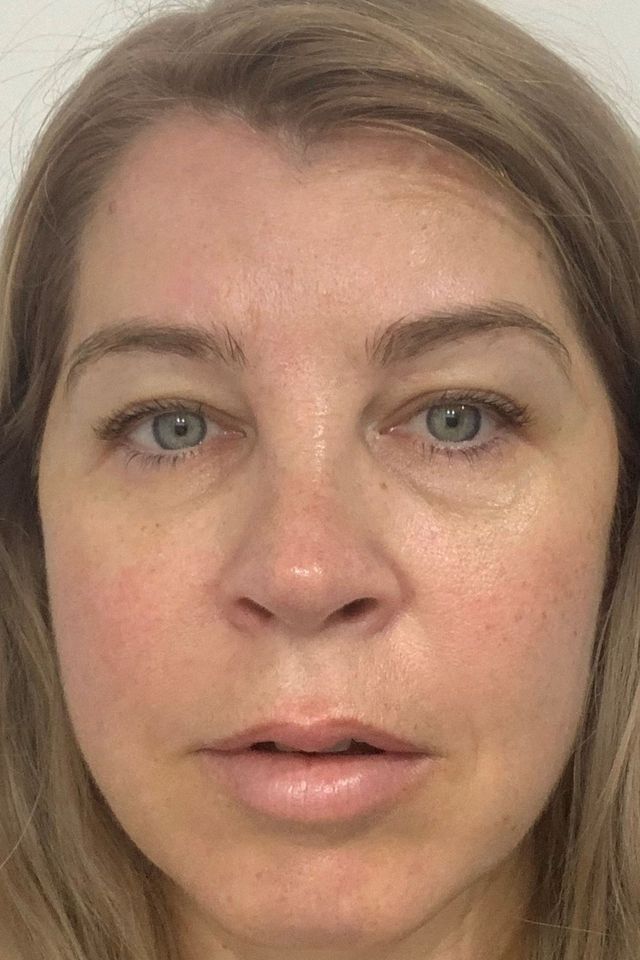Skin before using ESK skincare, example 17