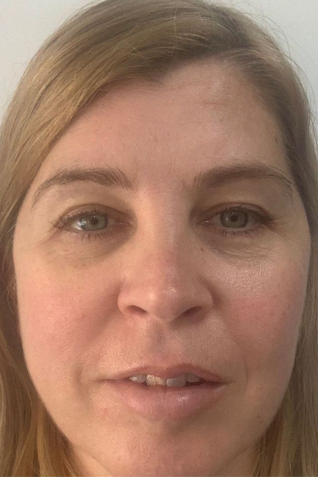 Skin after using ESK skincare, example 17