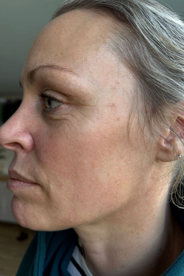 Skin before using ESK skincare, example 18