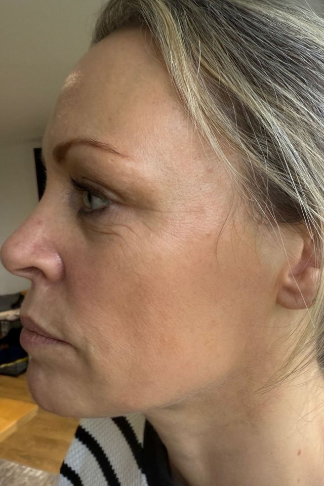 Skin after using ESK skincare, example 18