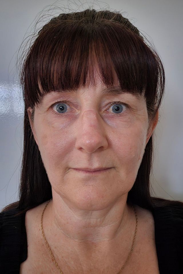 Skin before using ESK skincare, example 19