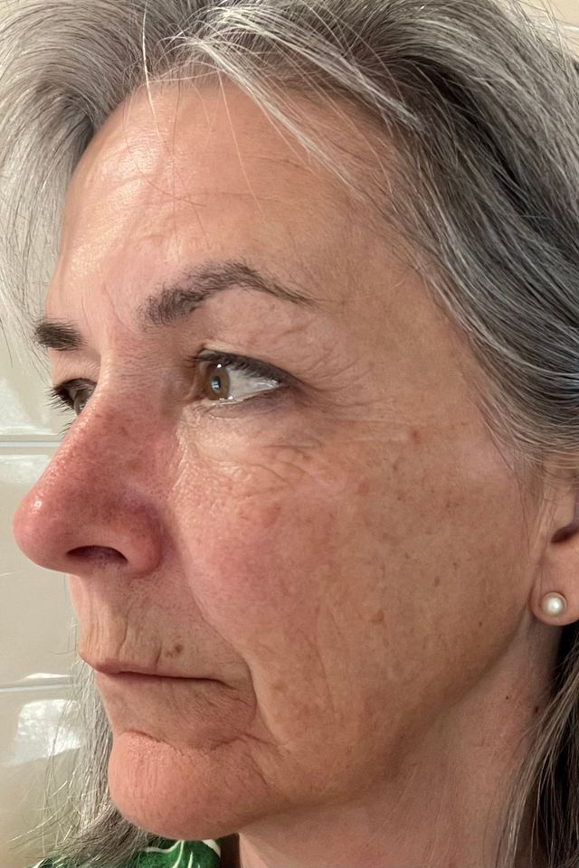 Skin before using ESK skincare, example 20