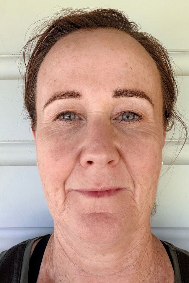 Skin before using ESK skincare, example 21