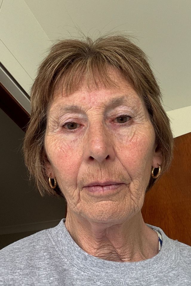 Skin before using ESK skincare, example 23