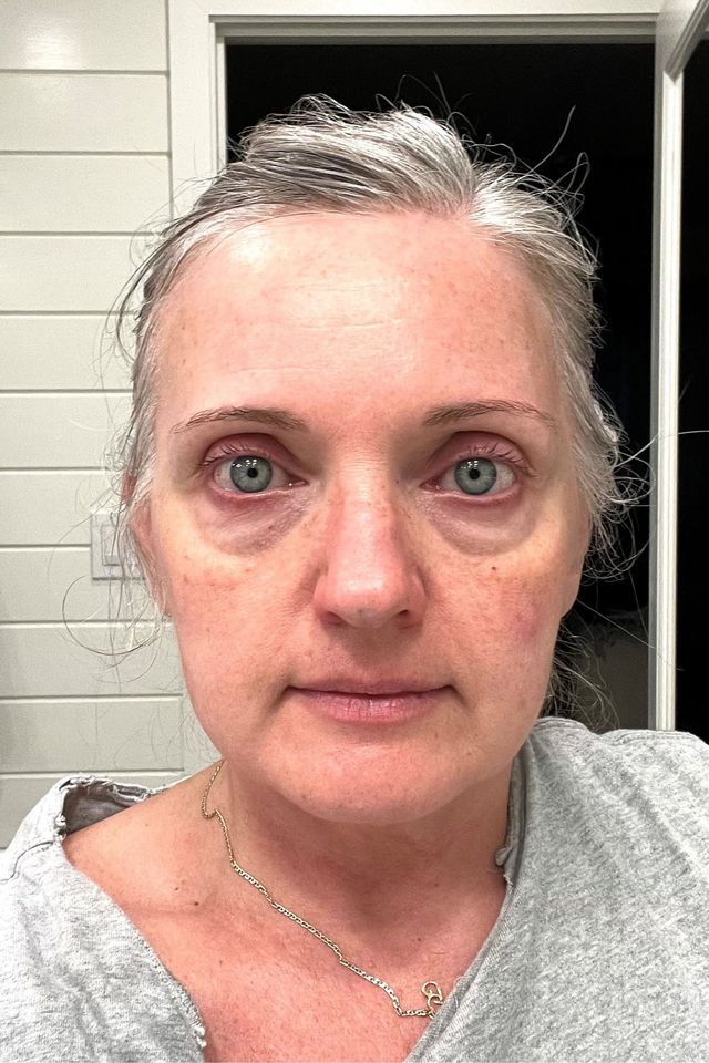 Skin before using ESK skincare, example 24