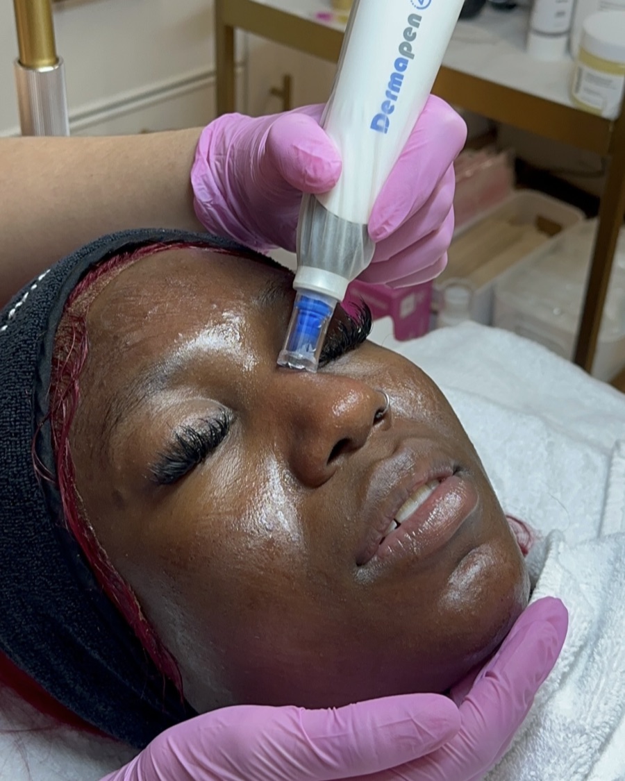 Microneedling on melanin-rich Fitzpatrick VI skin at Melatone Skin Clinic Battersea, with melanin-safe parameters