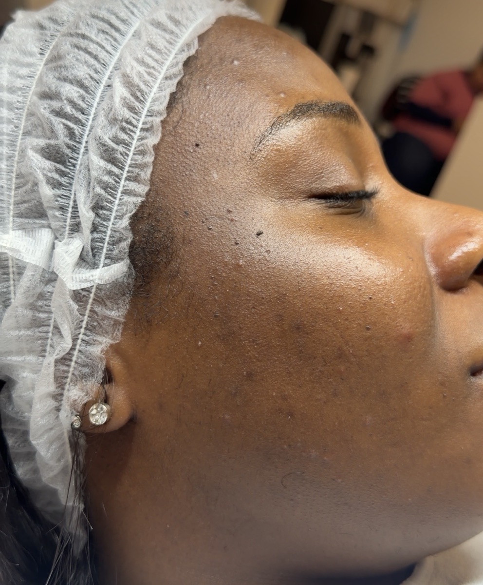 Close-up of a Fitzpatrick V to VI patient's cheek during consultation at Melatone Skin Clinic Battersea, showing scattered post-inflammatory hyperpigmentation marks across the mid-cheek with otherwise intact barrier, photographed under clinical lighting.
