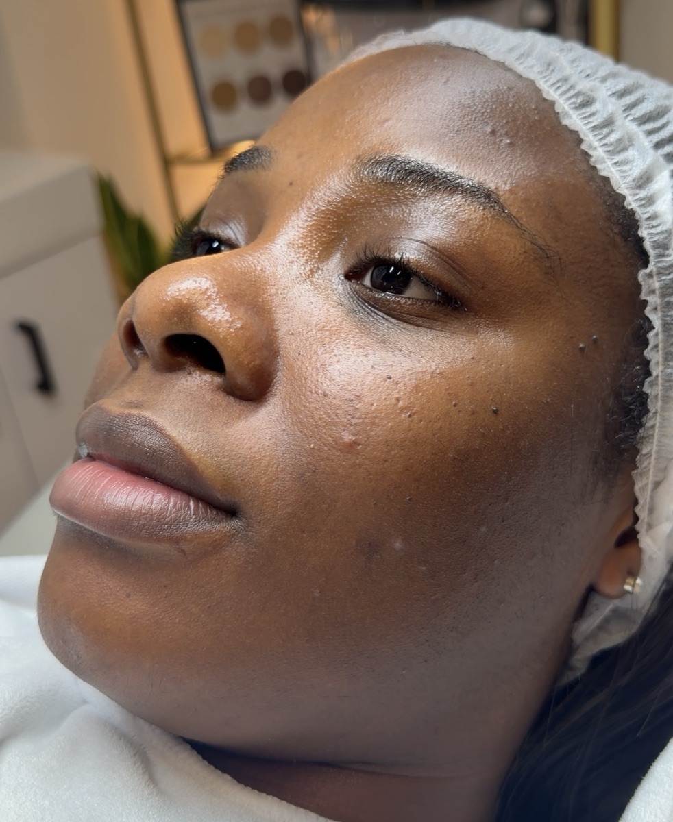 Three-quarter clinical close-up of a Fitzpatrick V to VI patient at Melatone Skin Clinic Battersea, showing fine textural irregularity across the mid-face with scattered superficial pigmentation, photographed mid-consultation under clinical lighting.